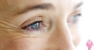 How to Remove Under-Eye Wrinkles?