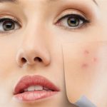 sivilce-lekeleri-icin-maske