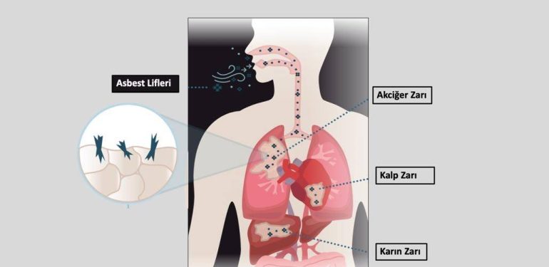 Mezotelyoma Hastalığı Nedir ?
